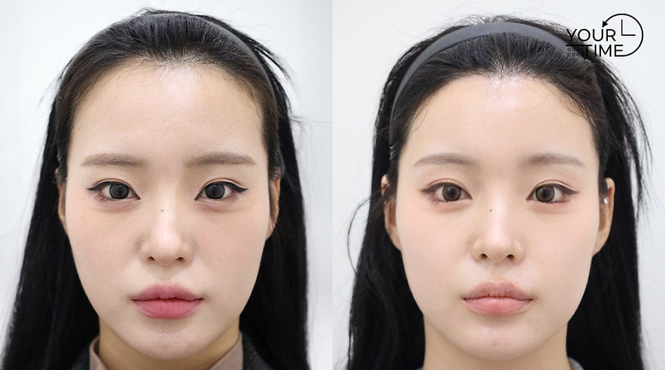 Hairline Lowering Surgery vs. Hair Transplant: Pros and Cons Compared — 4