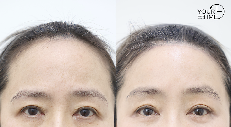 Hairline Lowering Surgery vs. Hair Transplant: Pros and Cons Compared — 6