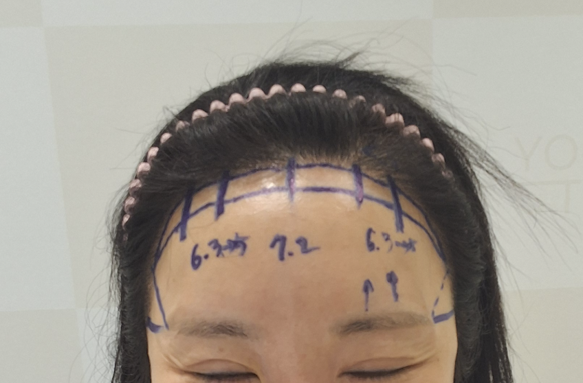 Hairline Lowering Surgery vs. Hair Transplant: Pros and Cons Compared — 7