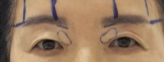 Why a 1 cm Incision Can Be One of the Hardest Surgeries