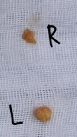 Why a 1 cm Incision Can Be One of the Hardest Surgeries — 2