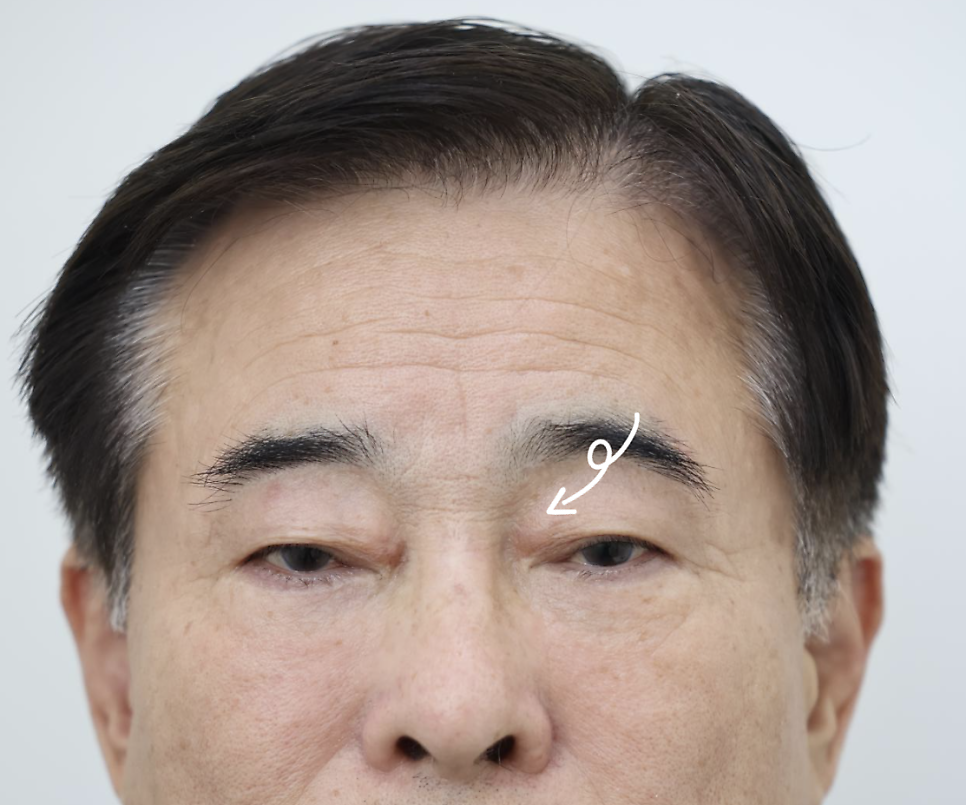 Why a 1 cm Incision Can Be One of the Hardest Surgeries — 3