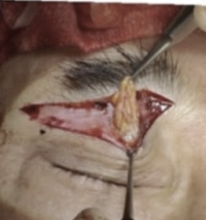 Why a 1 cm Incision Can Be One of the Hardest Surgeries — 4