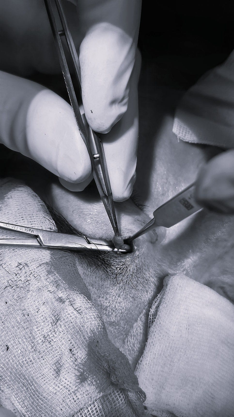 Why a 1 cm Incision Can Be One of the Hardest Surgeries — 5