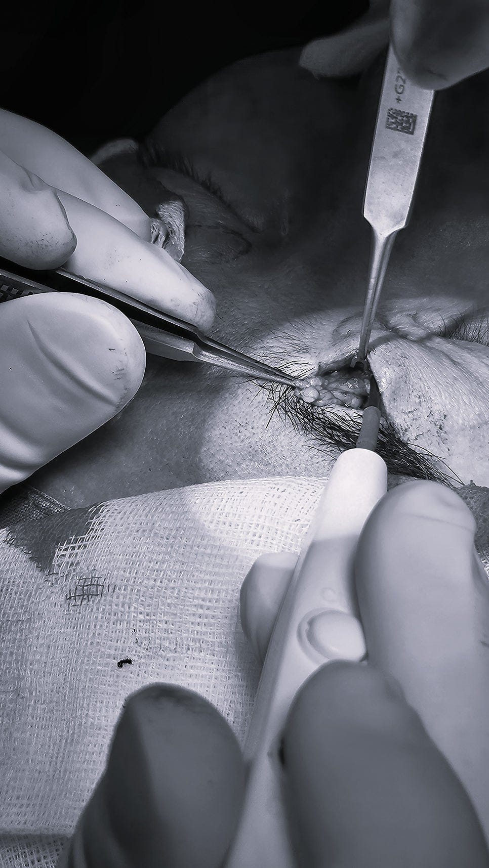 Why a 1 cm Incision Can Be One of the Hardest Surgeries — 6