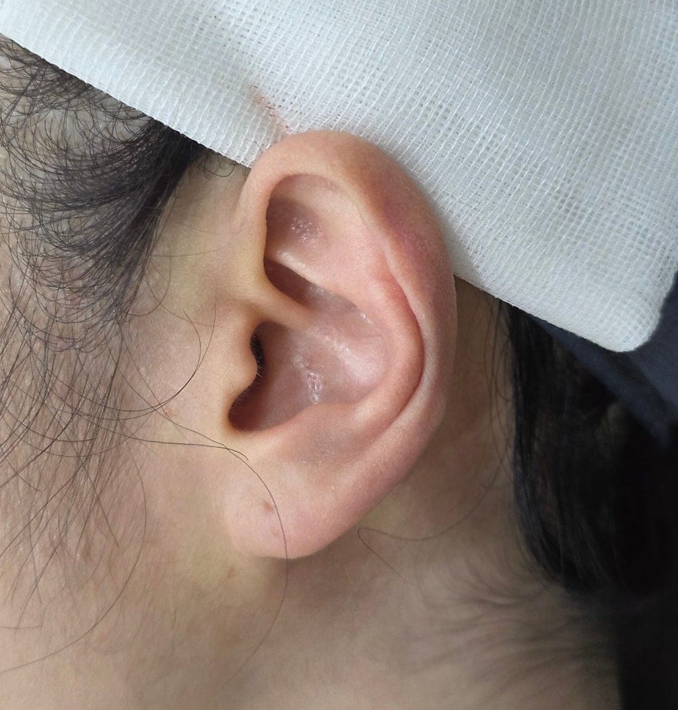 Ear Filler for Folded or Collapsed Ear Cartilage