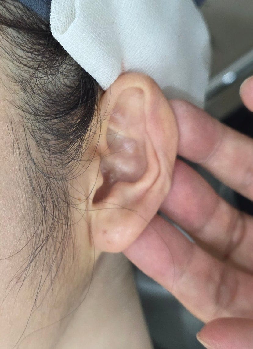 Ear Filler for Folded or Collapsed Ear Cartilage — 2