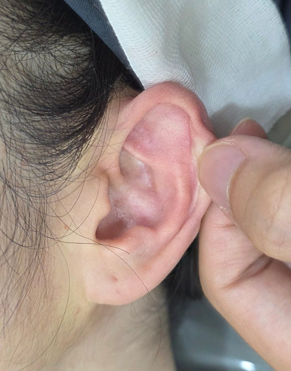 Ear Filler for Folded or Collapsed Ear Cartilage — 3