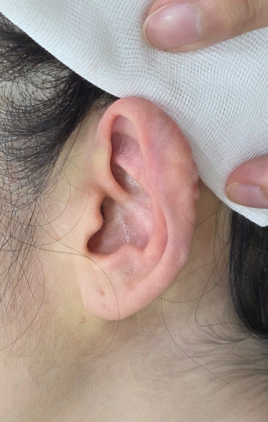Ear Filler for Folded or Collapsed Ear Cartilage — 4
