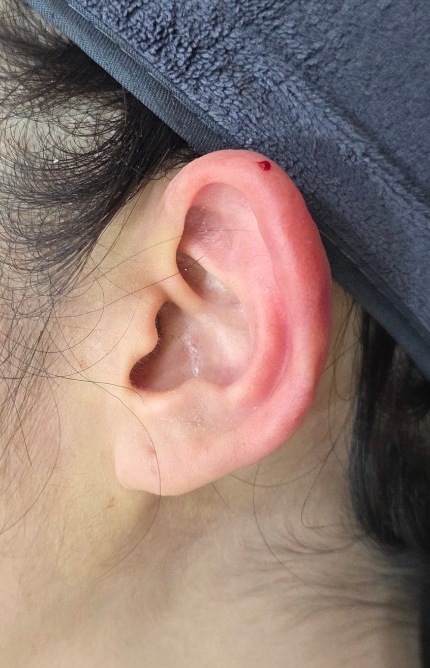 Ear Filler for Folded or Collapsed Ear Cartilage — 5