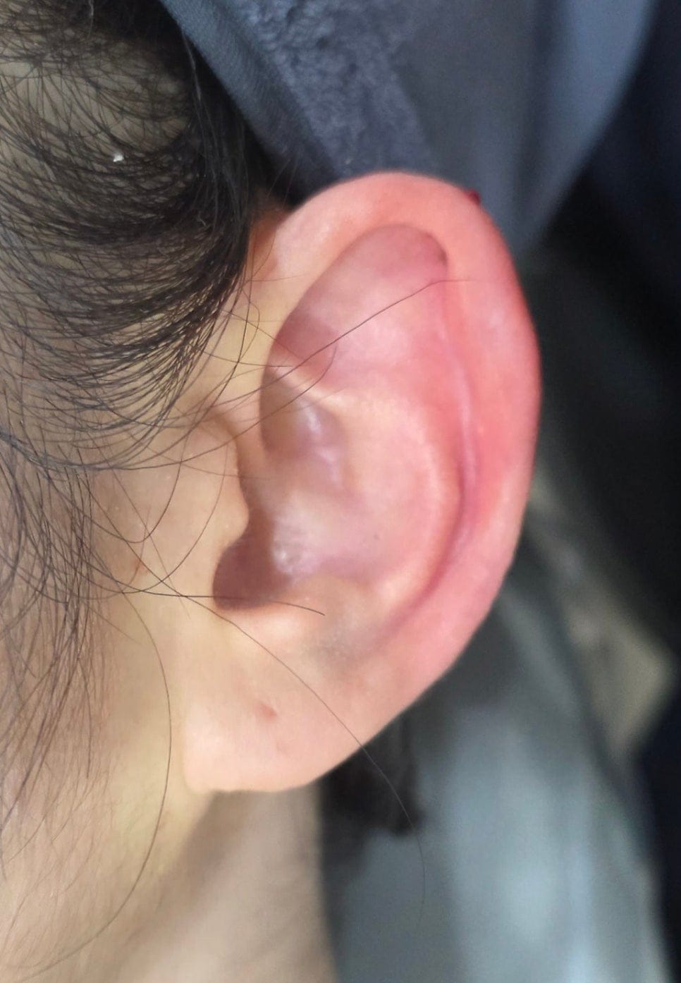 Ear Filler for Folded or Collapsed Ear Cartilage — 6