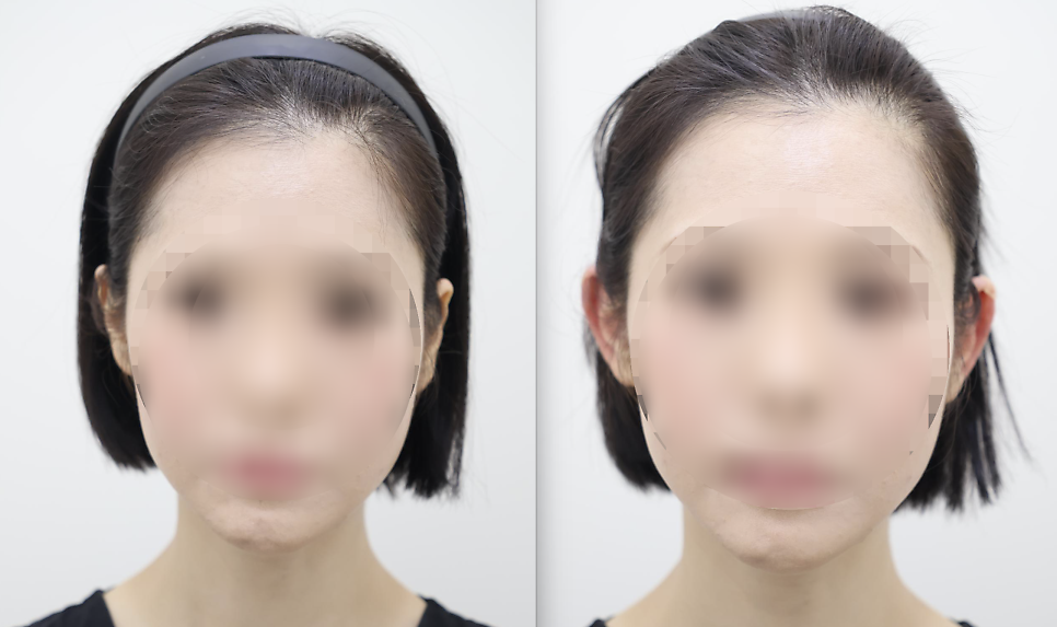 Ear Filler for Folded or Collapsed Ear Cartilage — 7