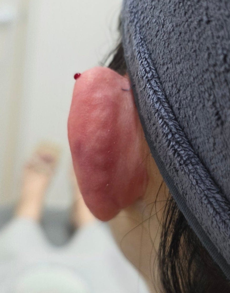 Ear Filler for Folded or Collapsed Ear Cartilage — 8