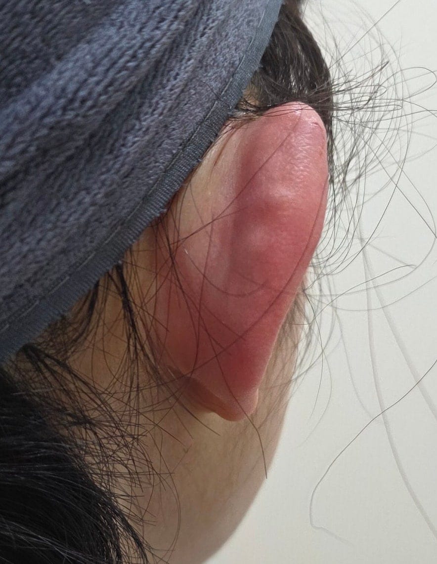 Ear Filler for Folded or Collapsed Ear Cartilage — 9