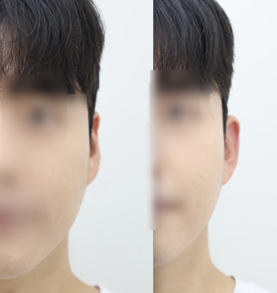Ear Filler for Men: Reshaping Flat or Folded Ears — 4