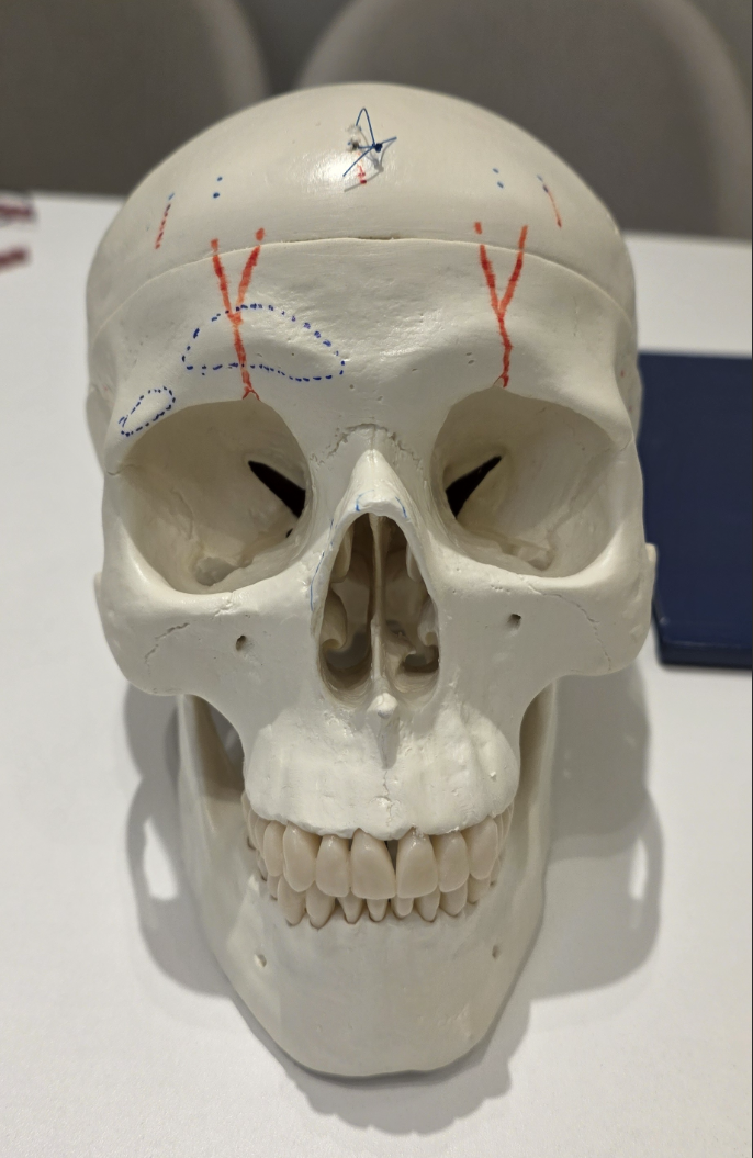 [Graphic Content Warning] Forehead Bone Reduction Surgery: The Actual Procedure (Video) — 2