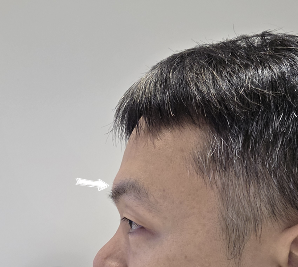 [Graphic Content Warning] Forehead Bone Reduction Surgery: The Actual Procedure (Video) — 4