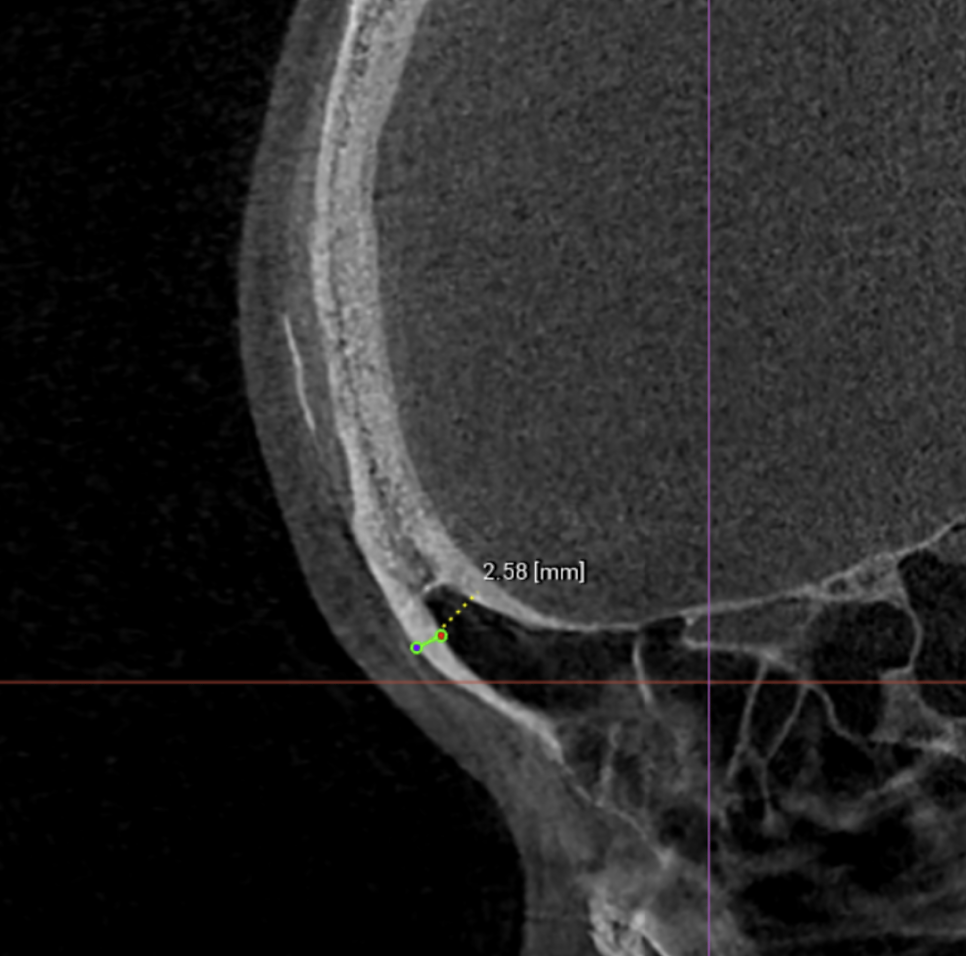 [Graphic Content Warning] Forehead Bone Reduction Surgery: The Actual Procedure (Video) — 5