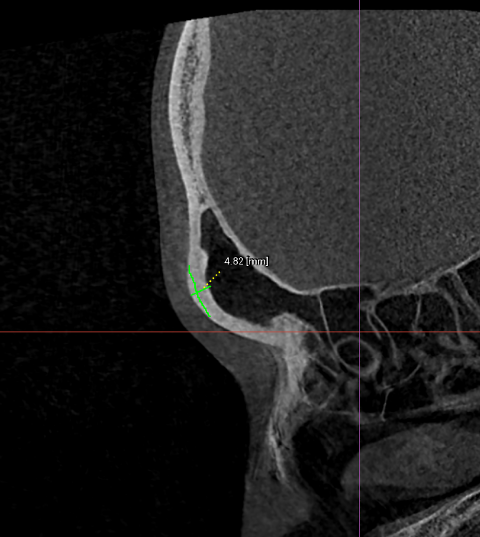 [Graphic Content Warning] Forehead Bone Reduction Surgery: The Actual Procedure (Video) — 6
