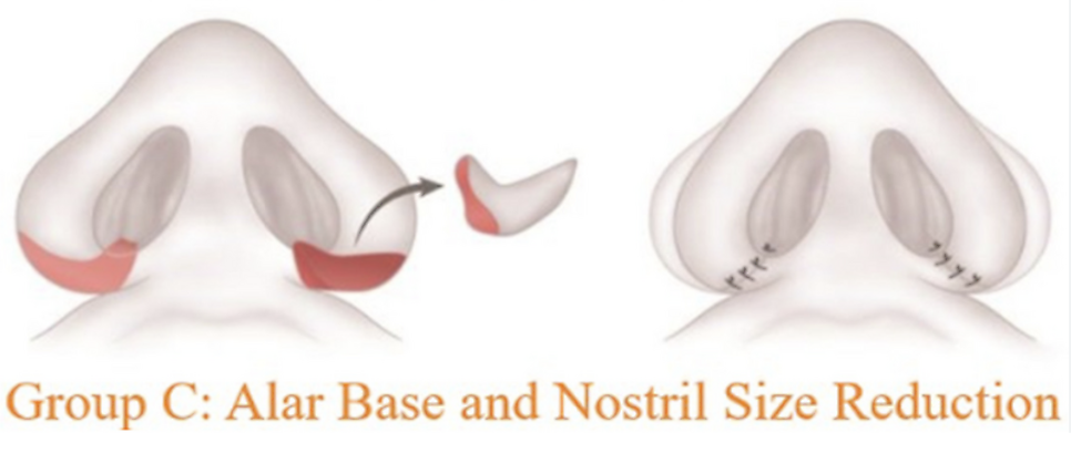 Not All Alar Base Reduction Surgeries Are the Same