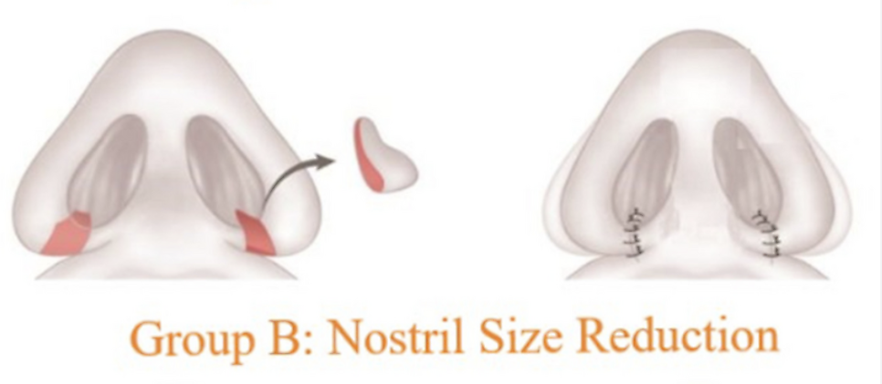 Not All Alar Base Reduction Surgeries Are the Same — 2