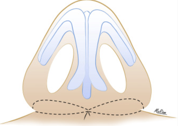 Not All Alar Base Reduction Surgeries Are the Same — 3