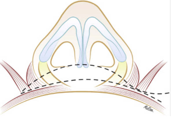 Not All Alar Base Reduction Surgeries Are the Same — 4