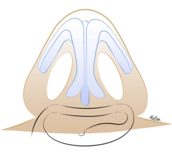 Not All Alar Base Reduction Surgeries Are the Same — 5