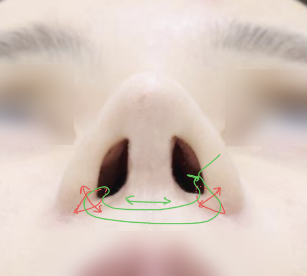 Not All Alar Base Reduction Surgeries Are the Same — 6