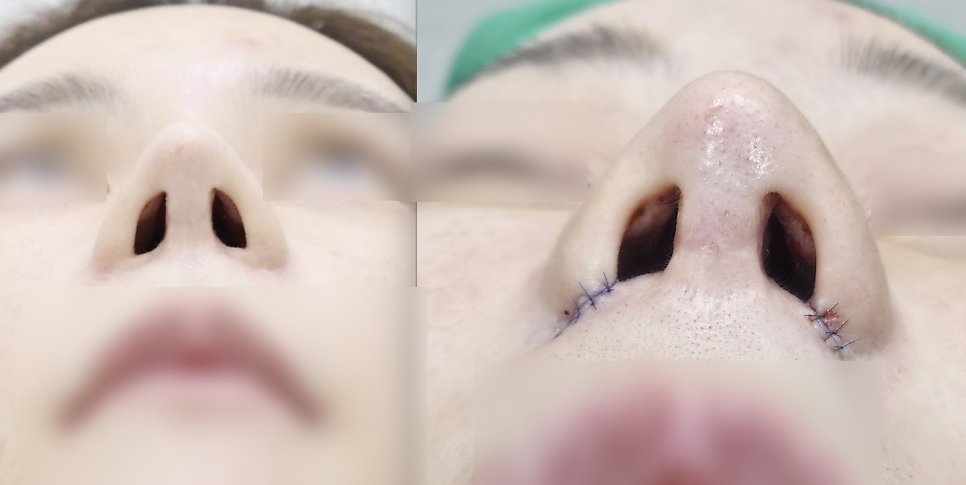 Not All Alar Base Reduction Surgeries Are the Same — 7