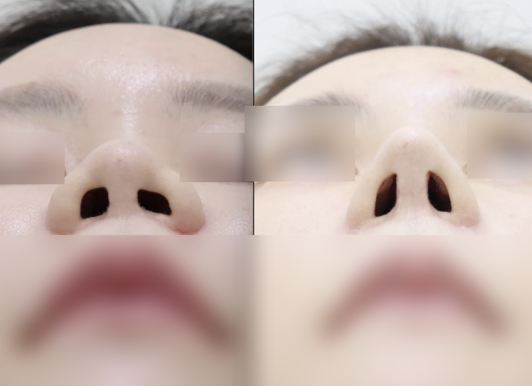 Not All Alar Base Reduction Surgeries Are the Same — 9
