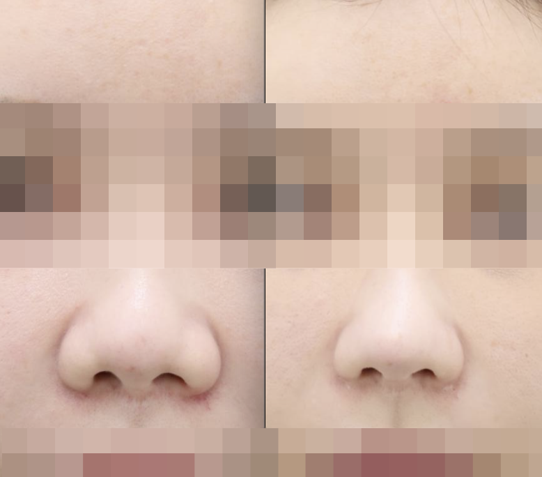 Not All Alar Base Reduction Surgeries Are the Same — 10