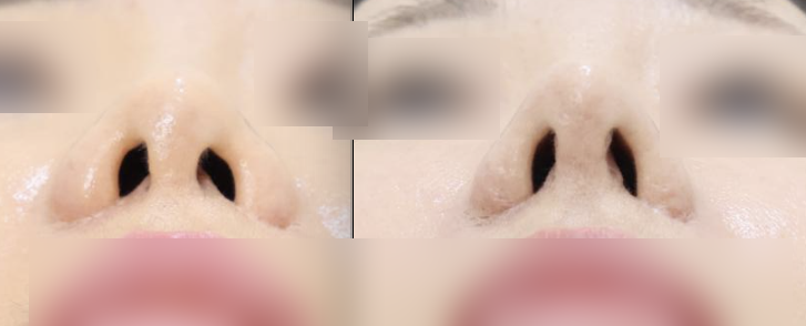 Not All Alar Base Reduction Surgeries Are the Same — 11
