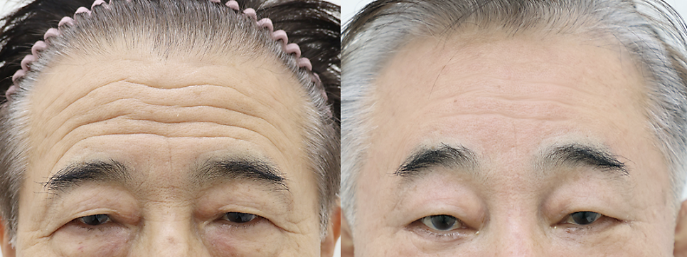 5 Things That Change After a Brow Lift: What to Expect — 2