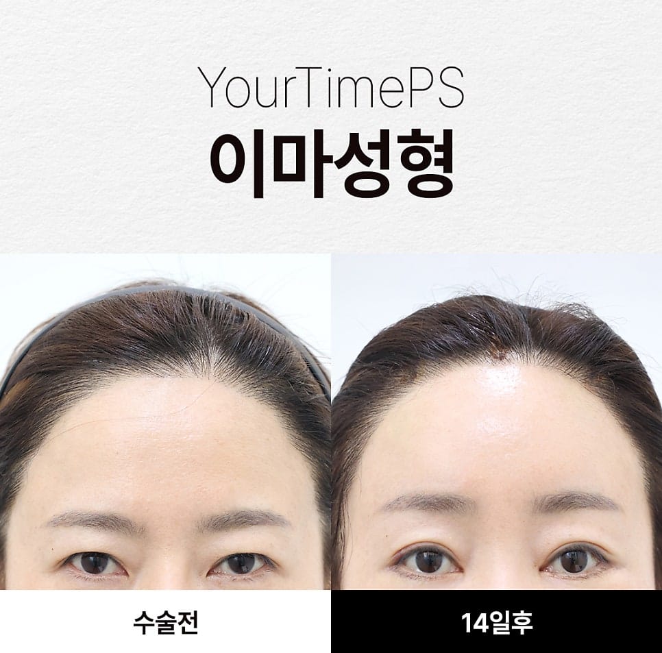 5 Things That Change After a Brow Lift: What to Expect — 7