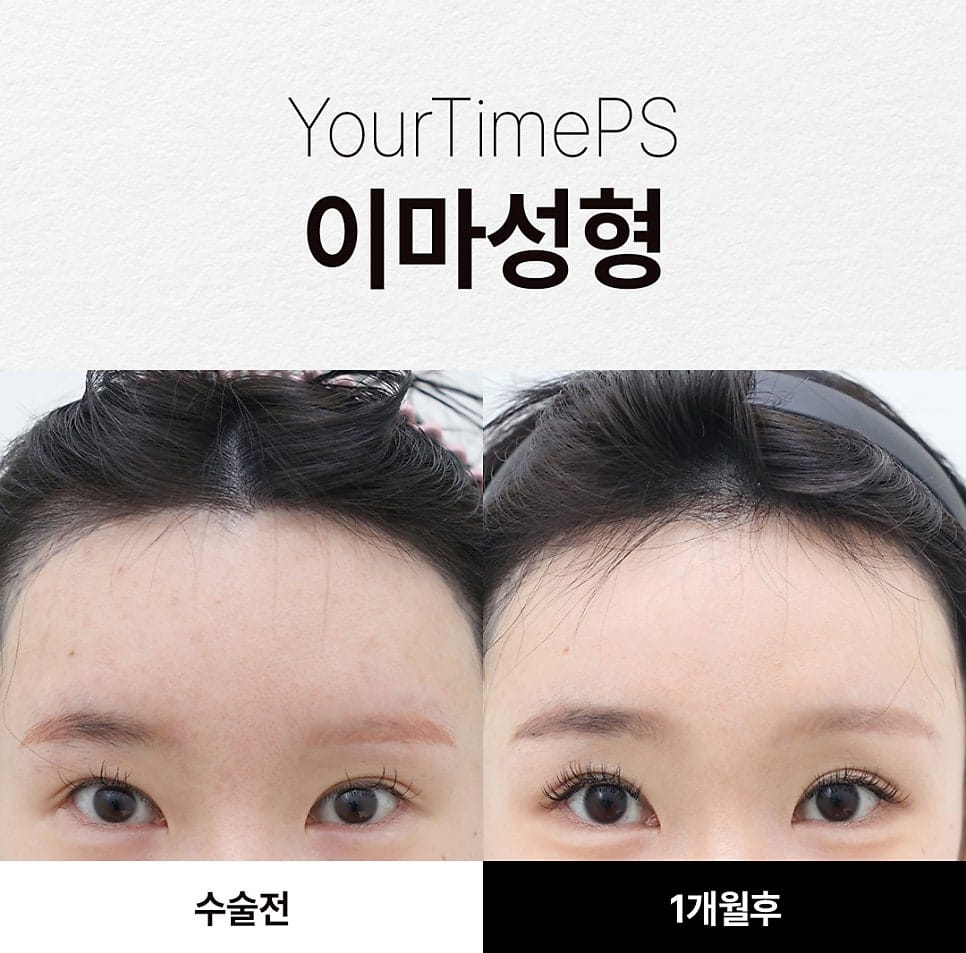 5 Things That Change After a Brow Lift: What to Expect — 9