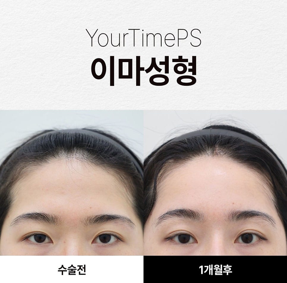 5 Things That Change After a Brow Lift: What to Expect — 10