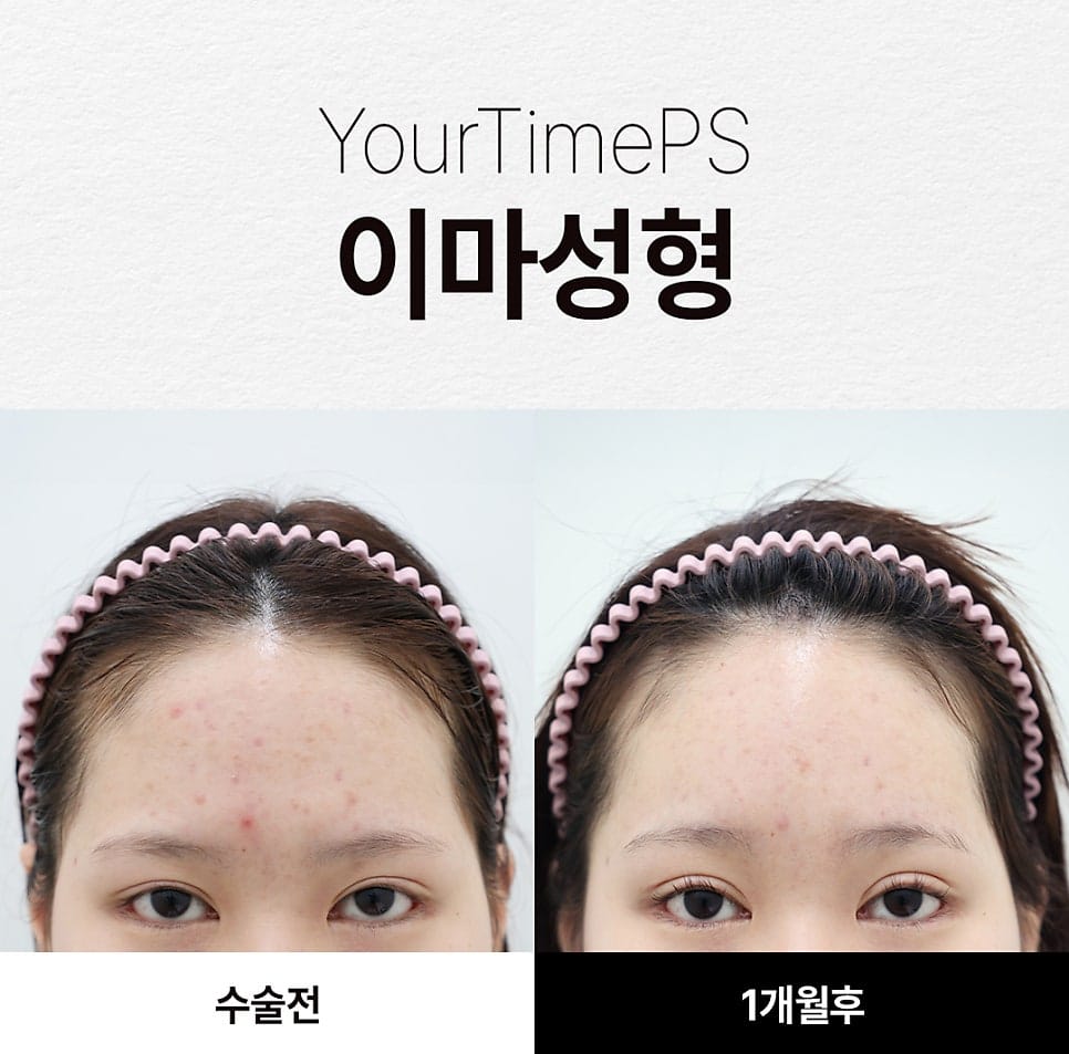 5 Things That Change After a Brow Lift: What to Expect — 12