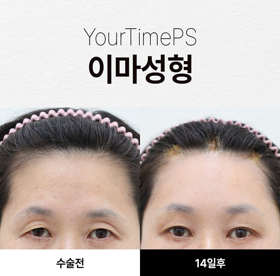 5 Things That Change After a Brow Lift: What to Expect — 13