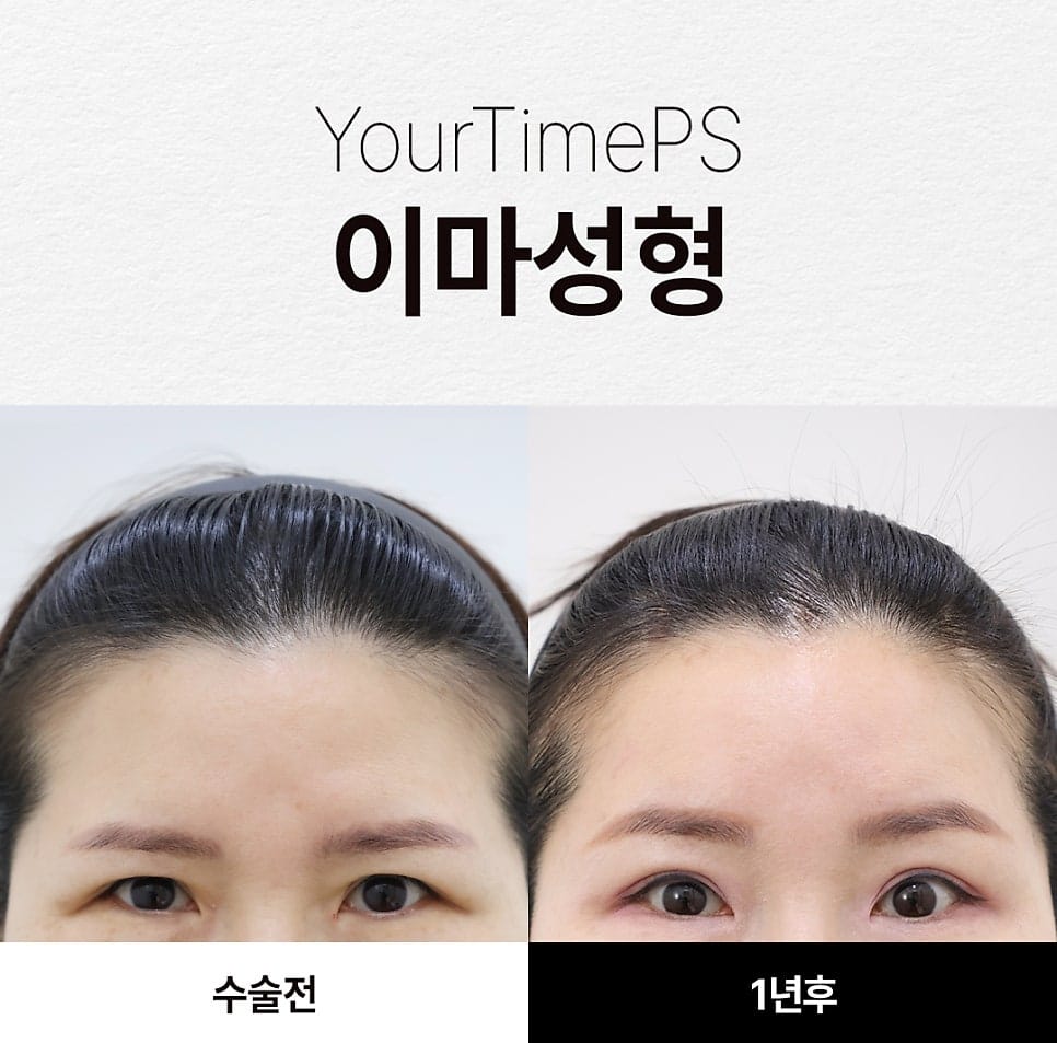 5 Things That Change After a Brow Lift: What to Expect — 14