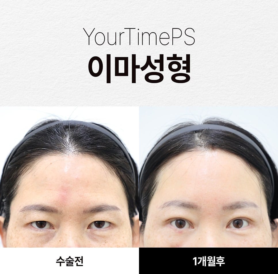 5 Things That Change After a Brow Lift: What to Expect — 15