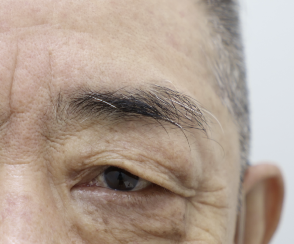 5 Things That Change After a Brow Lift: What to Expect — 16