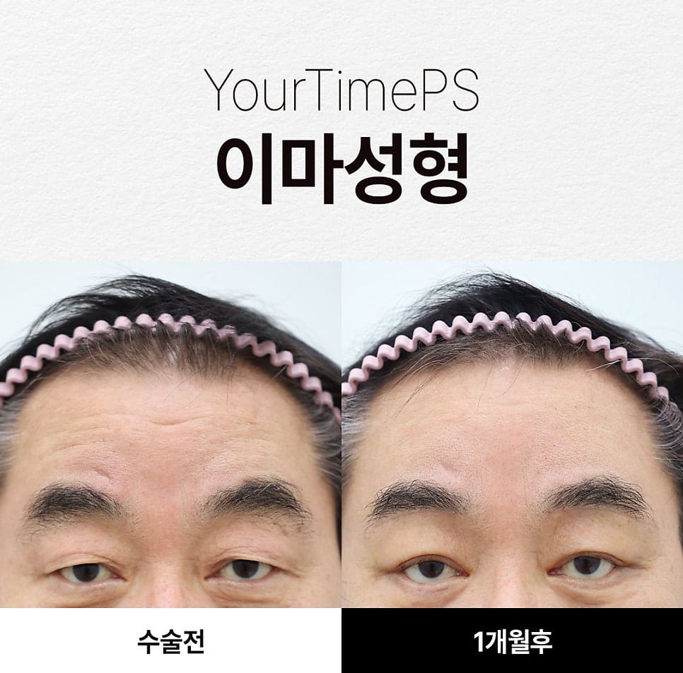 5 Things That Change After a Brow Lift: What to Expect — 19