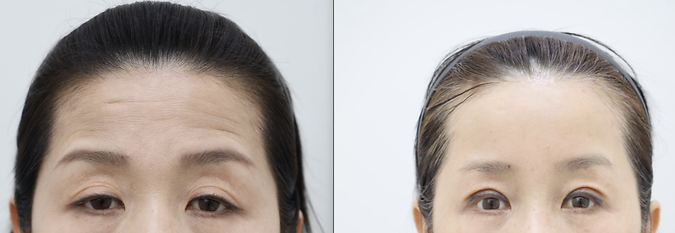 5 Things That Change After a Brow Lift: What to Expect — 20
