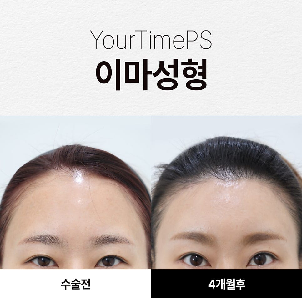 5 Things That Change After a Brow Lift: What to Expect — 21