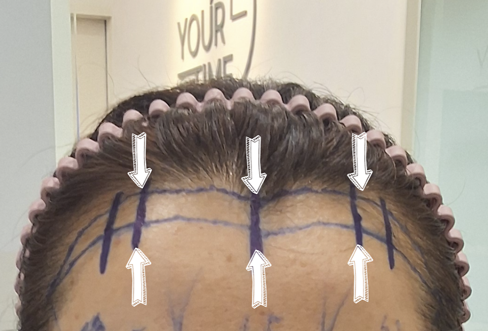 How to Reduce a Large Forehead Significantly (Feat. M-Shaped Hairline Recession) — 4