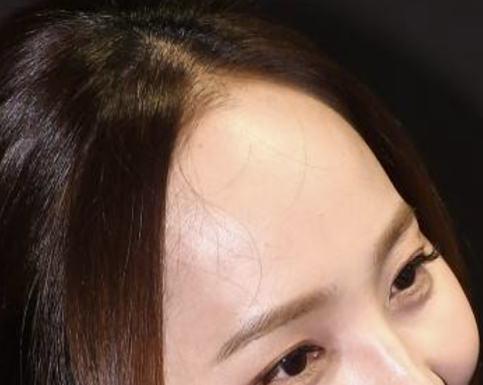 How to Reduce a Large Forehead Significantly (Feat. M-Shaped Hairline Recession) — 5