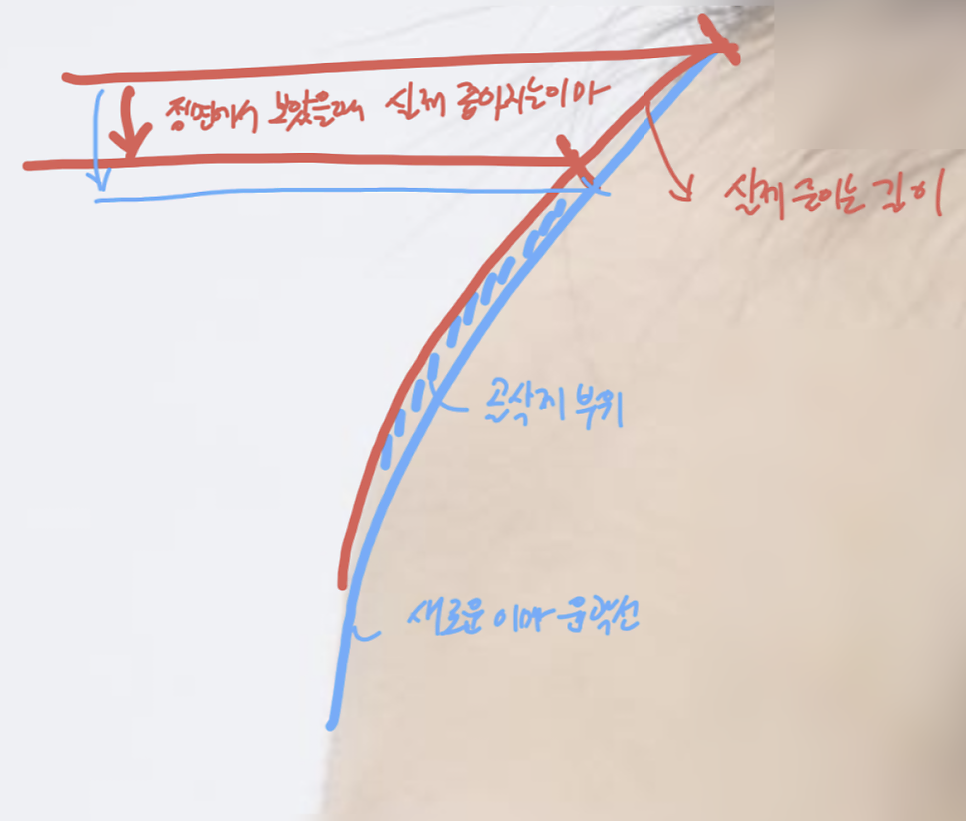 How to Reduce a Large Forehead Significantly (Feat. M-Shaped Hairline Recession) — 7