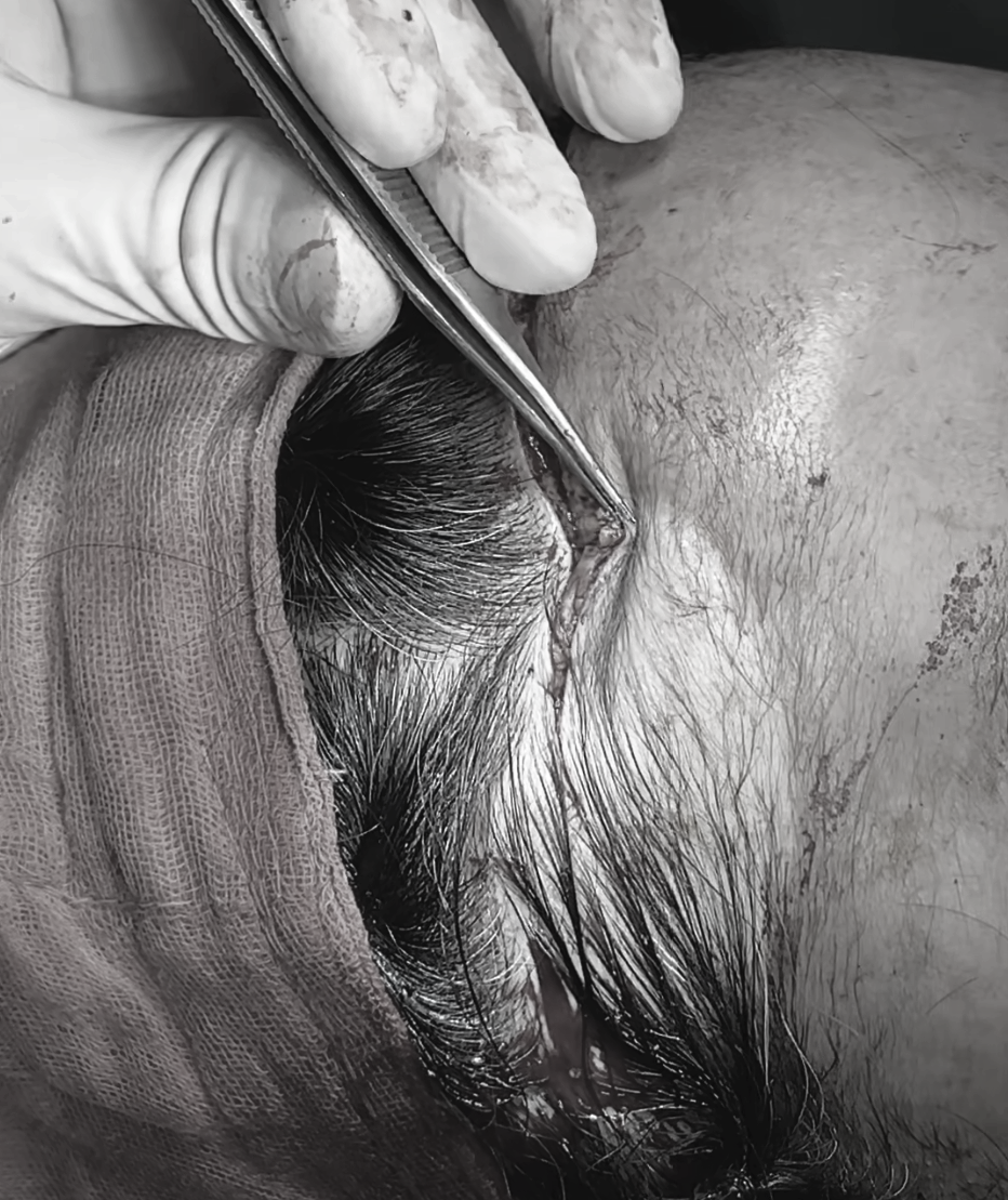 How to Reduce a Large Forehead Significantly (Feat. M-Shaped Hairline Recession) — 11