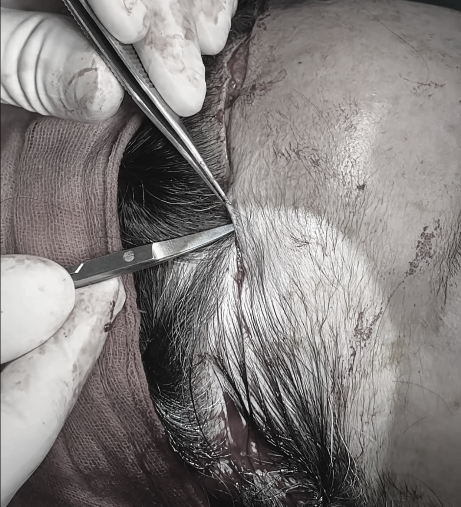 How to Reduce a Large Forehead Significantly (Feat. M-Shaped Hairline Recession) — 13